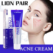 LION - Pair Acne Cream, Japan 𝐀𝐜𝐧𝐞 𝐓𝐫𝐞𝐚𝐭𝐦𝐞𝐧𝐭 𝐏𝐢𝐦𝐩𝐥𝐞𝐬 Removal Cream,