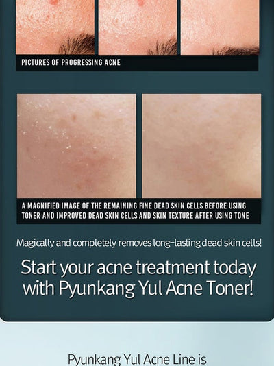 ACNE Acne Treatment -Acne Facial Cleanser 120ml by Pyunkang Yul