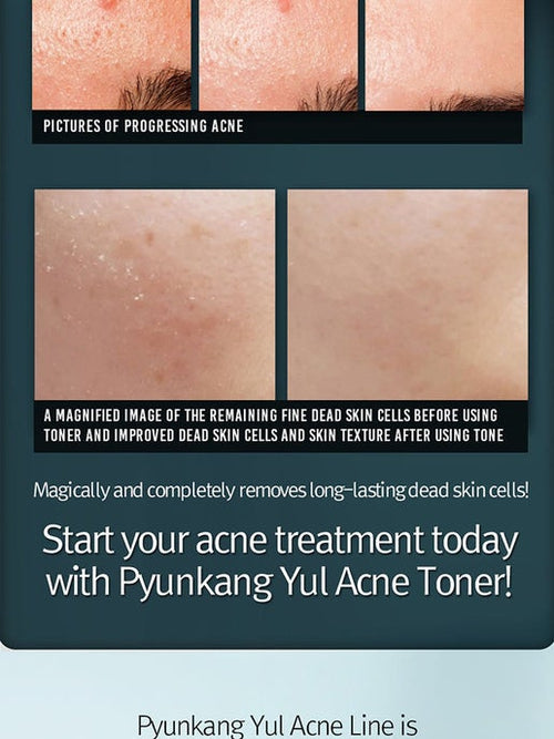 Acne Treatment Toner 150ml. - Salicylic acid BHA Astringent for Face - Natural Ingredients removing Dead Skin Cells and Minimizing Pores- By Pyunkang Yul - elizkofbeauty